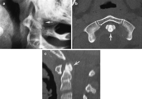 Anomalies and Normal Variations of the Dens | Radiology Key