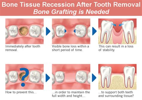 Dentist Glendale: Bone Grafting Types, How and Why Is It Done - Smile ...