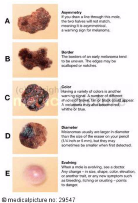 Abcde Skin Cancer Chart