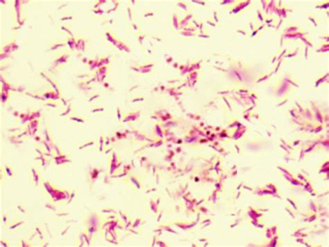 Mycobacterium Kansasii Article