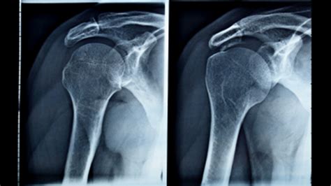 Shoulder Arthritis Surgery