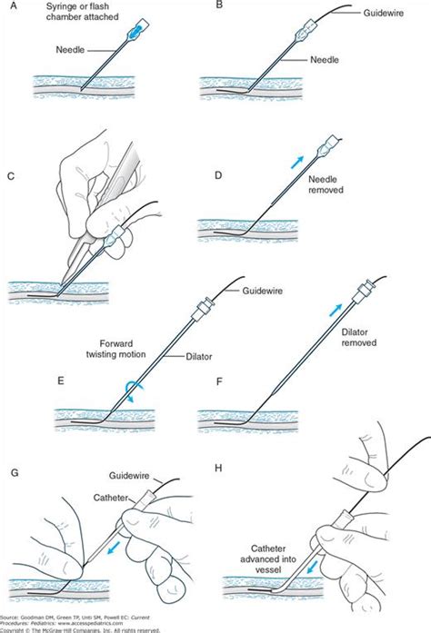 Femoral Venous Catheterization | Obgyn Key