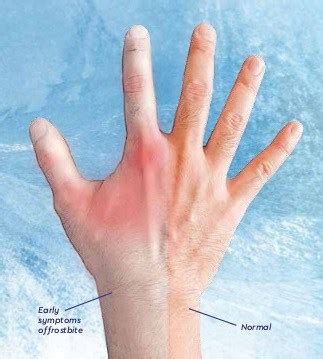 The Symptoms and Stages of Frostbite - ShoenSafety LLC