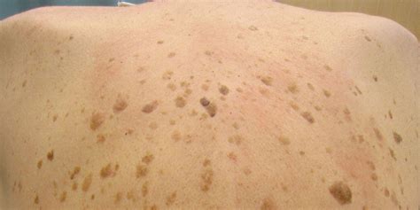 Portland Seborrheic Keratosis Treatment | Norris Dermatology