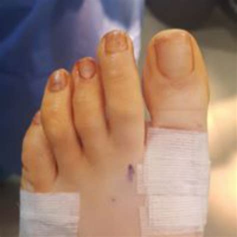 Before & After | Podiatric Surgery Centre