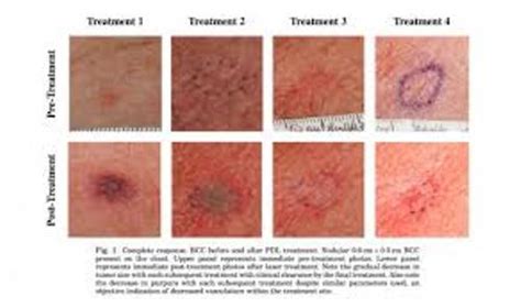 8 Facts about Basal Cell Carcinoma | Fact File