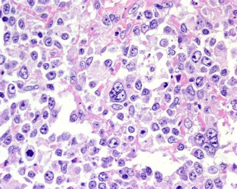 Diffuse Large B-cell Lymphoma, Anaplastic Variant - 3.