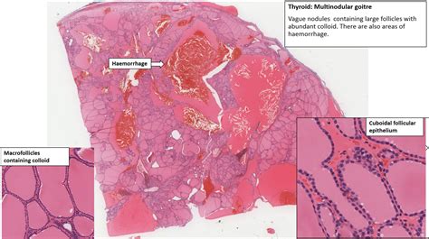 Multinodular Goiter Histology