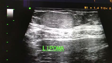 Lipoma ultrasound - YouTube