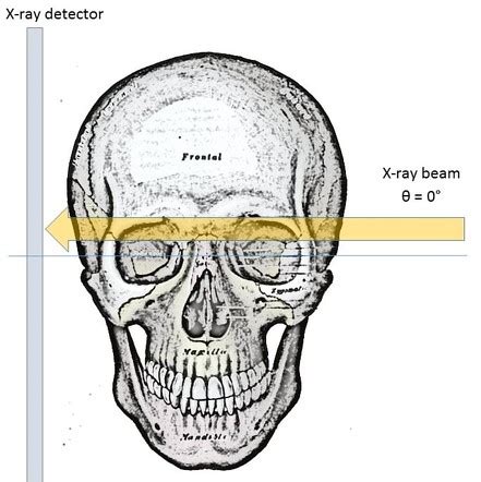 Skull (lateral view) | Radiology Reference Article | Radiopaedia.org