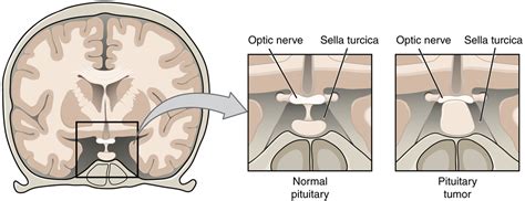 Prolactinoma Symptoms in Men and Women | Nervous System Disorders and ...