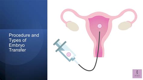 Embryo Transfer: Procedure and Types