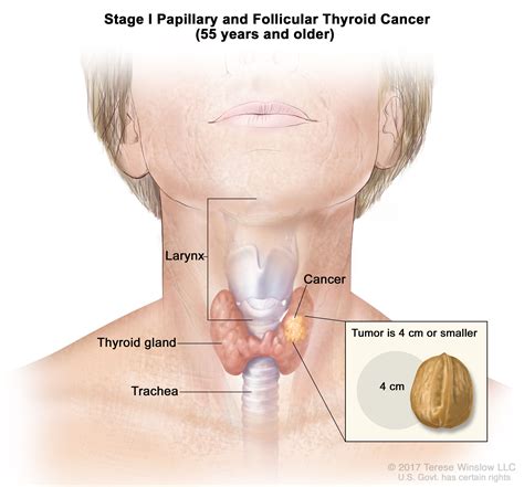 Thyroid Cancer Treatment (PDQ®)–Patient Version - NCI