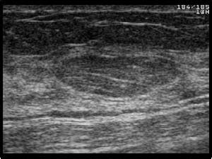 Axillary Lipoma Ultrasound