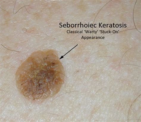 Seborrhoeic keratosis - MySkinDoctor