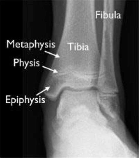 Triplane fracture causes, symptoms, diagnosis & treatment