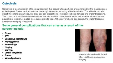 Complications of total knee replacement