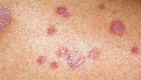 Diabetic skin rash images | Symptoms and pictures