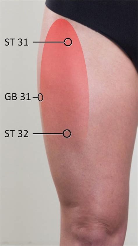 Meralgia Paresthetica: Lateral Femoral Cutaneous Nerve Entrapment