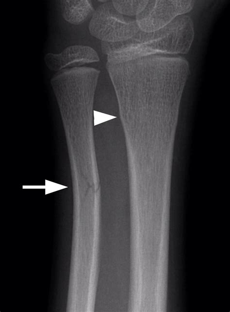 Greenstick Fracture Treatment