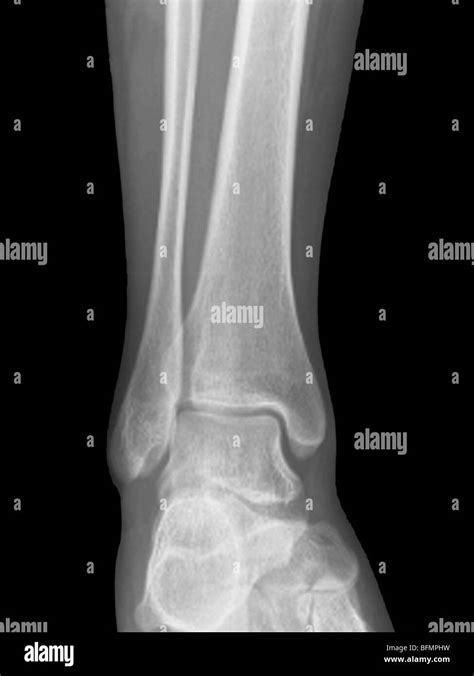 Normal ankle joint, X-ray Stock Photo - Alamy