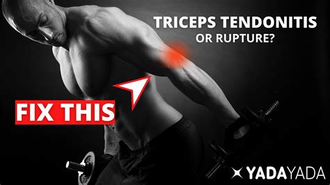 Triceps Tendonitis or Rupture? Signs, symptoms, and treatment options ...