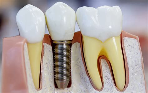 The Benefits of Titanium Dental Implants | Sensu