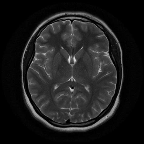 Collection 101+ Pictures Mri Pictures Of Brain Completed 10/2023