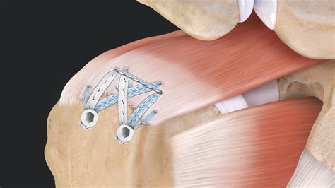 Arthrex - Compression SpeedBridge™ Rotator Cuff Repair