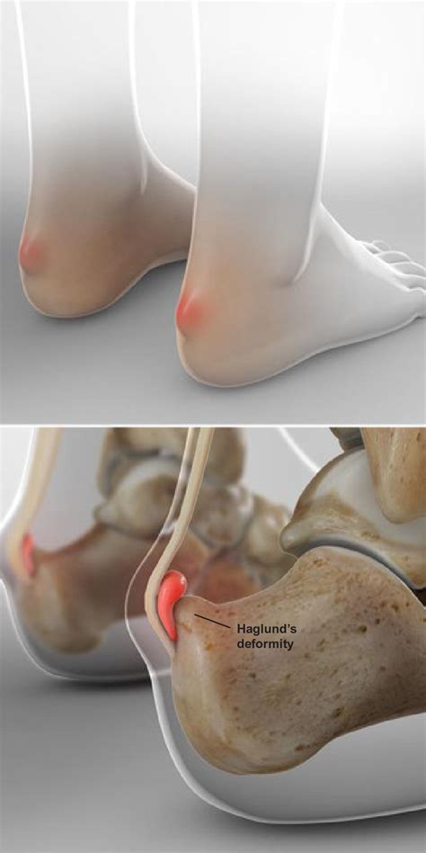 Achilles Tendon Bursitis