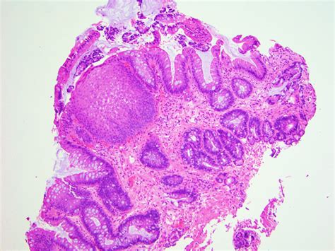 Barretts Esophagus Histology