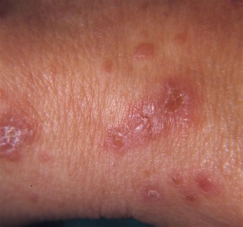 Dermatitis Herpetiformis; Duhring's Disease