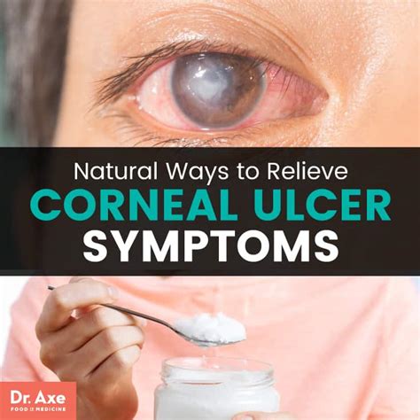 What Is a Corneal Ulcer? + Relieve Symptoms 11 Natural Ways | Best Pure ...