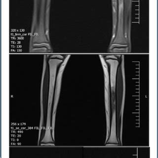 MRI PD image showed bone marrow edema with high signal intensity in the ...