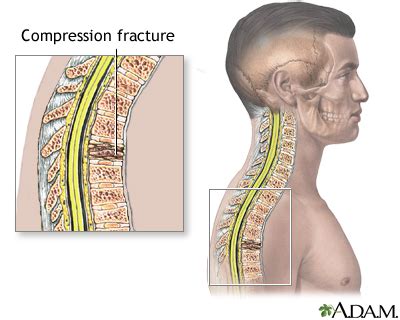 Compression fractures of the back | UF Health, University of Florida Health