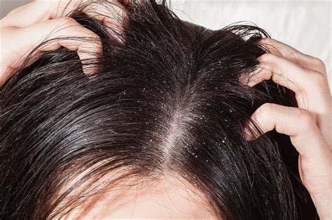 Defining dandruff, its potential causes and treatment options