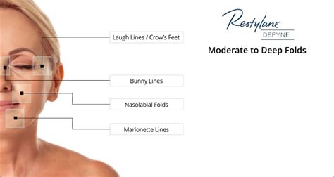 Restylane Defyne - MagnifaSkin MedSpa | Medical Spa in Wilmington, DE