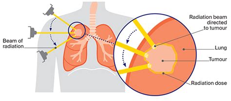 Radiation Therapy Side Effects