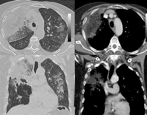 Case 28: 70-Years Old Lady with Non-Resolving Lung "Masses" and a Fat ...