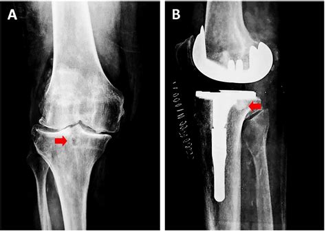 JCM | Free Full-Text | Subchondral Bone Cyst Development in ...