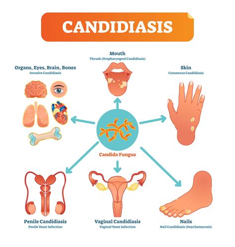 Candida Albicans - Effective Candida Treatment with IBS Clinics