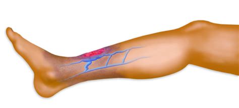 Performance Vein Institute of Los Alamitos: Chronic Venous ...