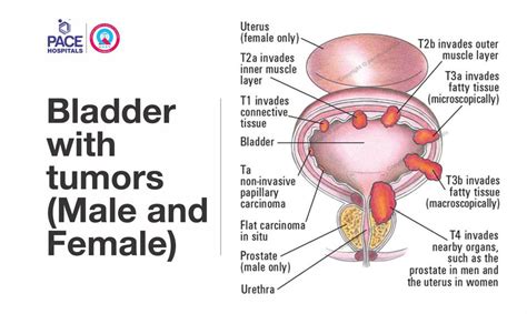 Transurethral Resection of Bladder Tumour (TURBT)