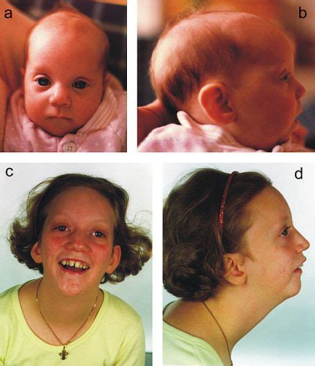 Difference Between Micrognathia and Retrognathia | Compare the ...