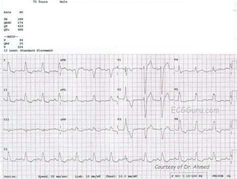 Left atrial enlargement | ECG Guru - Instructor Resources