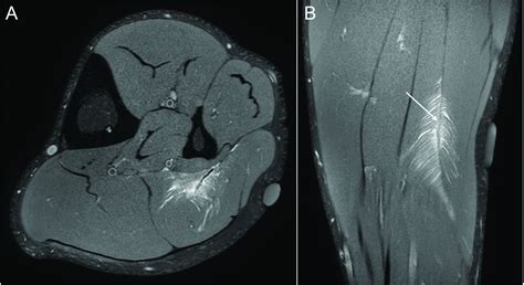 Connective tissue injury in calf muscle tears and return to play: MRI ...