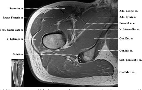 Upper Thigh Muscle Anatomy Mri - MRI anatomy of hip joint | free MRI ...