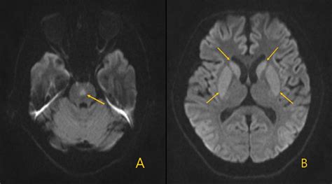 Cureus | Temporal Brain MRI Changes From Extrapontine Myelinolysis to ...