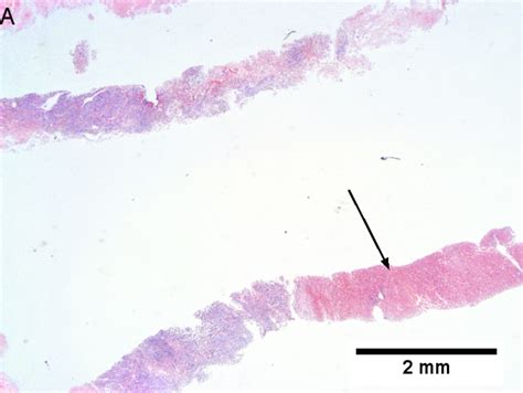 Liver metastasis - Libre Pathology