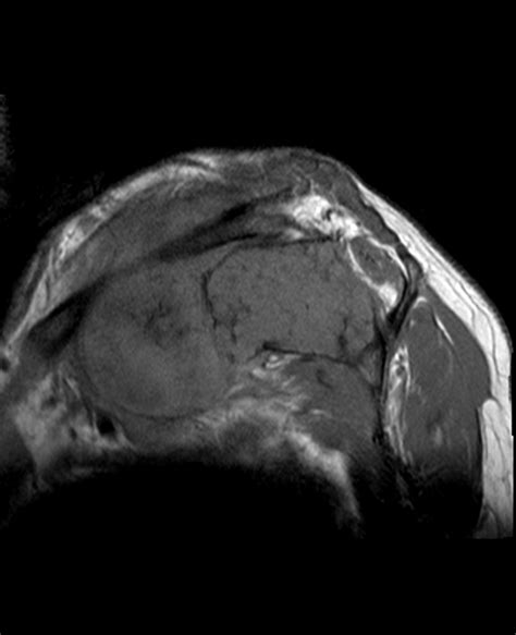 Chondrosarcoma | Image | Radiopaedia.org